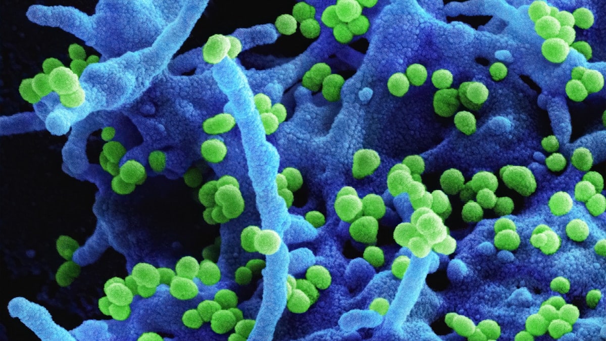 Lassa Virus Scanning electron micrograph of Lassa virus budding off a cell. Lassa virus (LASV) is an arenavirus that causes Lassa hemorrhagic fever, a type of viral hemorrhagic fever (VHF) in humans and other primates. Image captured and colorized at the NIAID Integrated Research Facility (IRF) in Fort Detrick, Maryland. Credit: NIAID https://www.flickr.com/photos/niaid/51719109817/